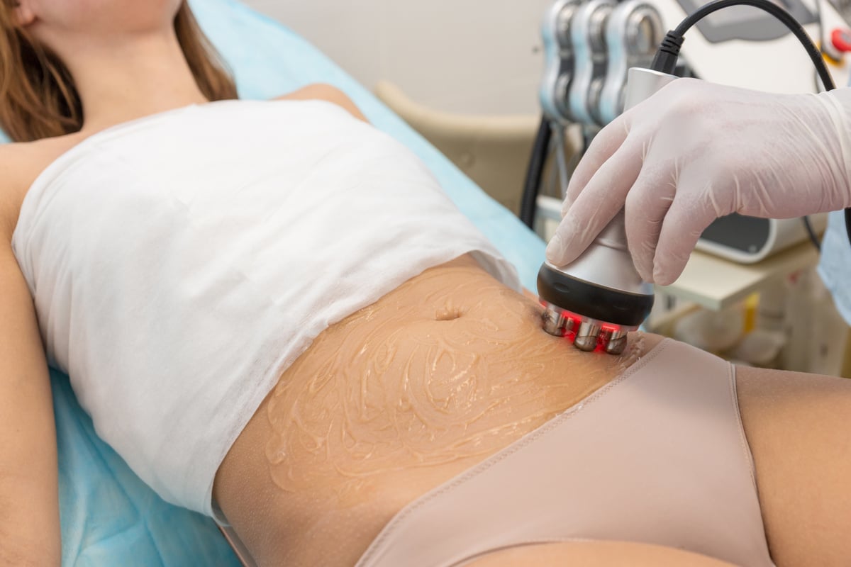 Radio frequency skin tightening, belly. Female body, cosmetology procedure.